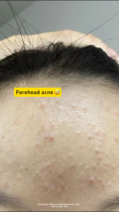 SKINEVER Salicylic Acid Scrub Cleanser Acne Treatment Niacinamide Scrub Cleanser Brightening Skin
