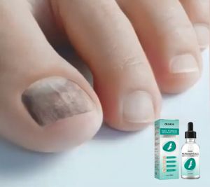 Obat Kuku Berjamur dan Rusak: Solusi Paling Ampuh