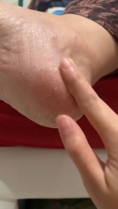 Kanna Cream Obat Krim Untuk Kaki Pecah Pecah Salep Gatal Kapalan Dan Kutu Air Pada Kulit Kering Dan Kasar Di Sela Jari Tangan Dan Telapak Kaki Jd Mulus