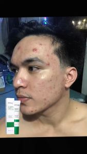 BIOAOUA Salicylic Acid Acne Removal Cream: A Comprehensive Guide