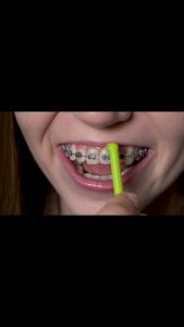 Bàn chải kẽ đầu nhỏ CoralClean orthodontic vệ sinh mắc cài