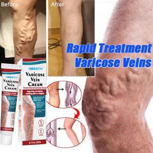 14 Days Varicose Veins Treatment Cream Varicose Veins Remover Effectively Dredge Vein Effectively Soothing Varicose Vein Soothing Leg Pain and Earthworm Leg Relief Leg Vasculitis Phlebitis Pain