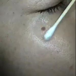 Freckle removal serum Whitening reckle removal serum Whitening Freckle removal Melasma Age spots Hereditary spots Pigmentation spots Sun spots Herbal whitening freckle removal