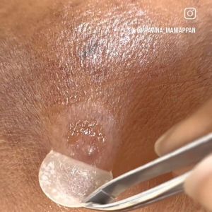 Troubless MICRO-POINT PATCH 9 x 1pcs - A Micro-sized Repair Solution