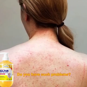 【READY STOCK】Anti Mite Itching Shower 500ml Acne body wash acne treatment Whitening Shower Gel Itchy Antibacterial body wash Remove Mites Whitening