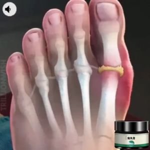 [Super effective] Gout ointment for big toe swelling joint and knee pain arthritis rheumatism and bone pain effective pain relief without recurrence natural Chinese herbal gout ointment 35g