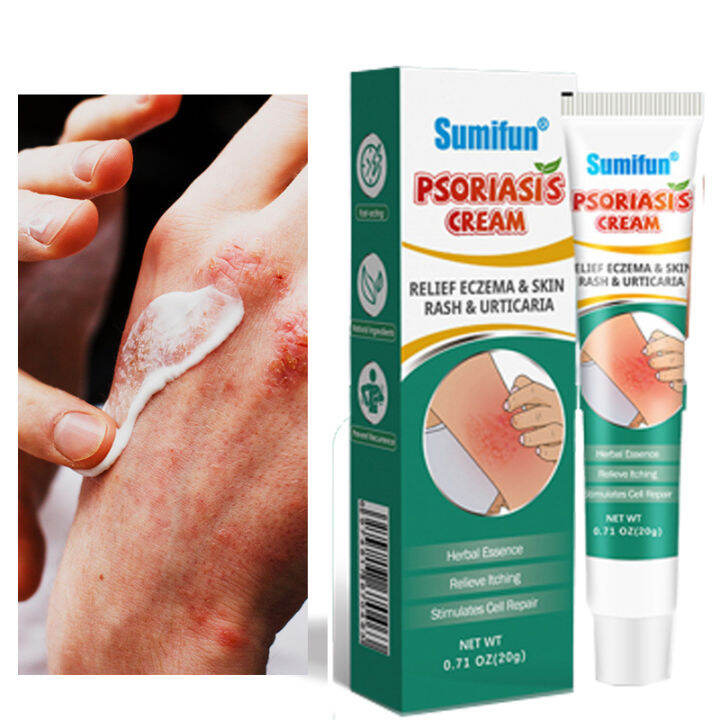 Psoriasis ointment treatment for dermatosis, dermatitis, eczema treatment, cream keratosis, rash, fungal infection, athlete's foot, antibacterial cream (skin care ointment / antibacterial cream / allergy rash cream / ringworm itch ointment)