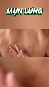 Xit mụn lưng ngực Freeskin 80ml gel tắm sữa tắm ngừa mụn freeskin 250ml giảm viêm nang lông mờ thâm sáng da giảm mụn cơ thể mờ thâm giảm viêm nang lông giảm sưng mụn dưỡng da sau mụn 80ml NOVOCARE- TUỆ LINH GARDEN