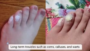 10 Pcs Feet Corns/ Warts Removal Patch Pain Relief Remover Feet Callus Remove Soften Skin Cutin Sticker Medical Plaster Feet Care Tool Foot Patch Warts Removal Patches Feet Corns Warts Removal Patchpain Relief 100% Authentic