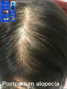 สเปรย์ปลูกผม สเปรย์ปลูกผม สำหรับผมบาง เร่งผมขึ้นใหม่ เร่งผมยาวไว ป้องกันผมร่วง น้ำยาปลูกผม น้ำยาเร่งผมยาว เซรั่มปลูกผม สเปรย์เร่งผม 30ml หรือ "สเปรย์ปลูกผม สำหรับผมบาง เร่งผมยาวไว น้ำยาปลูกผม 30ml