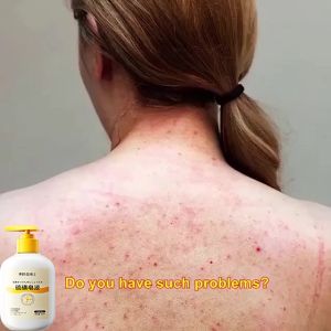 Acne and mite removing shower gel sulfur shower gel antibacterial mite removing bacteriostatic itching relieving moisturizing and skin rejuvenation shower gel 300ml