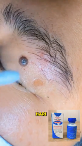 Penghilang Perontok Tahi Lalat Paling Ampuh Original