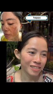 2023 HOT JAPANESE Melasma Cream White Spot Cream Skin Care Face Moisturizer Freckle Whitening Cream