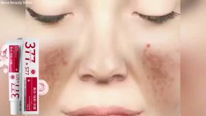 Powerful Spot-Removing Whiten Cream Brighten Skin Fast Eliminates Melanin Pigmentation Melasma Dark Spots Korean Face Skin Care