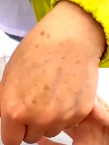 Dr.Li kem Xóa Đồi mồi Tàn nhang trên mặt & tay