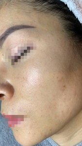 Peel căng bóng trắng da trẻ hoá da GIGI Ester C Peel