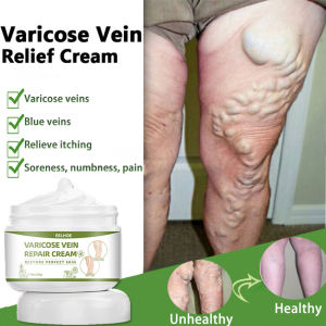 varicose veins treatment cream 靜脈曲張治疗蜘蛛静脉腿部护理 veins leg numb cream 50g Effective Remover Cream Spider Vein Pain Killer Cream Relieve promoting blood circulation expansion and unblocking blood vessels