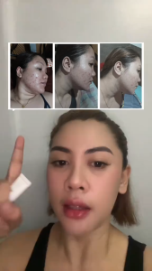 Best Seller 12% AZELAIC ACID CREAM | Authentic Niacinamide & Vitamin C Facial Serum to Reduce Pimples Dark Spot Rosacea Blackheads Scars & Oily Skin | Pigmentation Treatment for All Skin Types | Natural & Organic Formula | Dermatologist Recommended