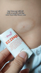 Blairy Eczema Balm 15g | Himalayan Soap 70g Psoriasis Eczema Acne anti cracking foot and hand protection stick cracks and dry Anti-Cracking moisturizer