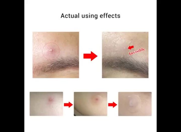 Curated visual reference: Fresh Look at Tea Tree Daily Night Acne Acne Removal Treatment