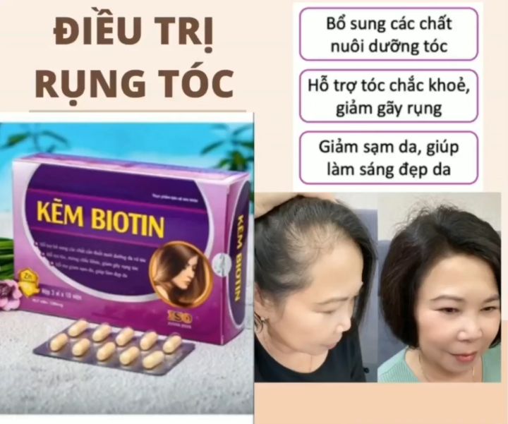 Kẽm biotin mọc tóc ngăn rụng tóc
