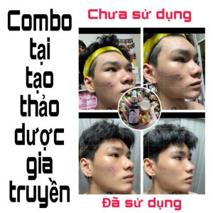 CHÍNH HÃNG -Combo Kem Face Tái Tạo Da Da Truyền Giúp Da Căng Bóng Mịn Màng Sạch Nám Mụn Tàn Nhang  Lọ 30gr