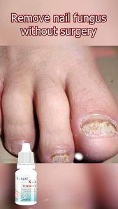 Serum Nấm Móng Tay Chân Lanthome Fungal Nail Treatment Sạch Nấm Bọng Móng Hư Khoé Cứng Móng 99%