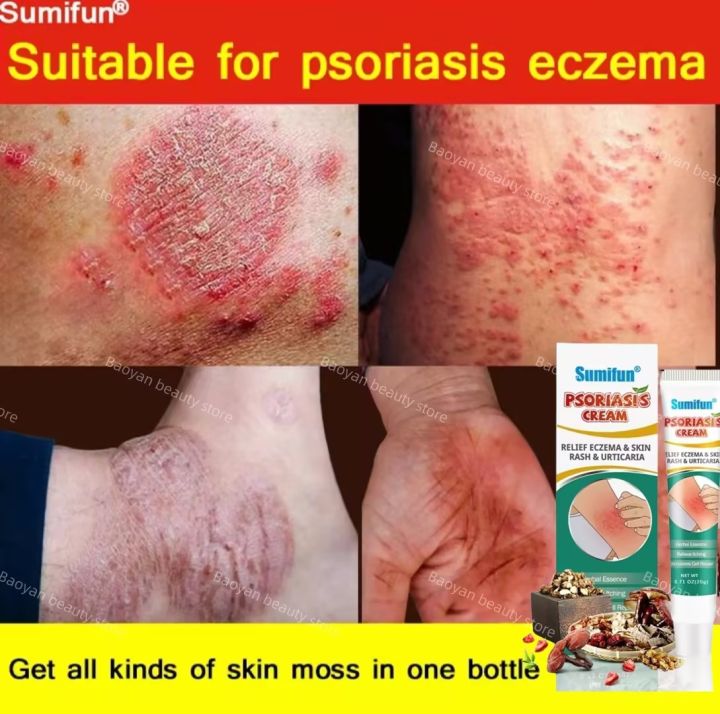 Sumifun Original Psoriasis Eczema Cream Antibacterial Antiitching