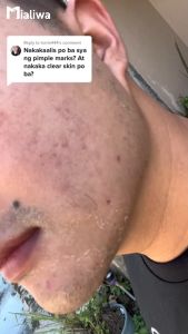 Blem Dr The Ultimate Pekas Cream & Toner Whitening Exfoliating Rejuvenating Moisturizer Face Cream Beauty Skin Care Niacinamide Aloe Vera Calamansi Dark Spot Melasma Freckles Pore Pimple Acne Blackheads Oil Control Anti Aging Glass Skin For Men & Women
