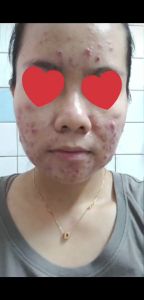 Jglow Skincare Acne Night Cream Untuk Kulit Berjerawat Mencerahkan Wajah Melembabkan - 125g