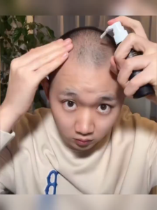 [100% Asli] Serum Penumbuh Rambut Minoxidil 5% Penumbuh Rambut Cepat — 30ml Serum Penumbuh Rambut Cepat untuk Kebotakan