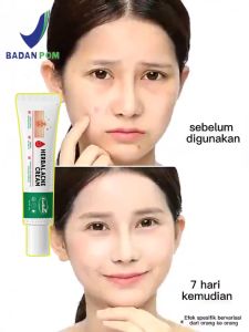 Krim Penghilang Jerawat Herbalife: Efektif & Ampuh