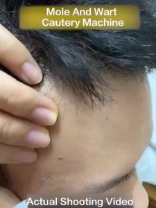 [Metaverse] Singapore Spot & Mole Removal Portable Home Beauty Equipment Laser Freckle Electronic Device
