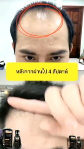 【โปร 1 แถม 1💫】แชมพูผมร่วง แชมพูขิง ยาสระผมแก้ร่ว 250ml ซ่อมแซมผมเสีย（แชมพูปลูกผม แชมพูผมยาว แชมพูสระผม แชมพูผมหนา แชมพูขิงเพียว แชมพูผมดก）