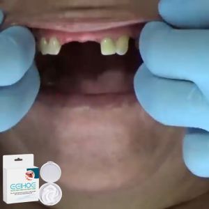 EELHOE Adjustable Snap-on Denture Adjustable Buckle Dentures Set Temporary Fillings Braces Gap Filling 1pair