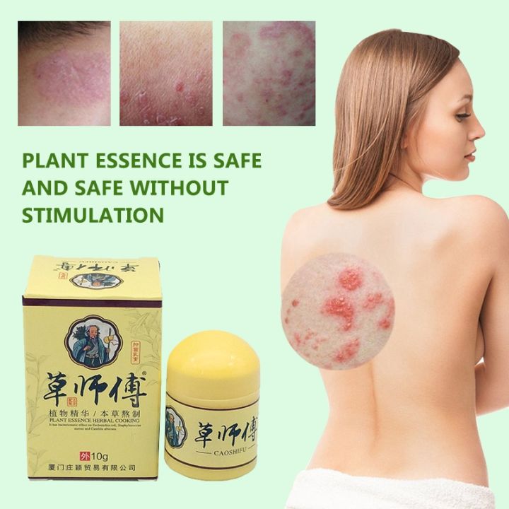 Caoshifu Ointment Cream Herbal Treatment Cure For Itchy Skin Allergy Like Eczema Psoriasis 3343