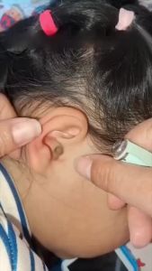 Alat Pembersih Telinga dengan Lampu LED Set Penjepit Kuping Bayi Anak Aman & Praktis