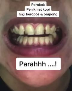 snap on smile 100% Original Authentic / gigi palsu snapon smile 1 set veneer gigi palsu