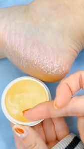 combo 5 lọ Kem Hết Nứt Nẻ Da Chân Tay Miệng Dưỡng Ẩm Mịn Ngay Sau Khi Thoa 20g