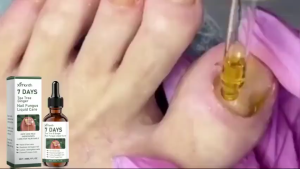 Kresin 7-Days Tea Tree and Ginger Nail Fungus Treatment Nail Cuticle Oil Liquid Strengthener Daily