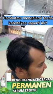 Myiwe Hair Growth Serum Penumbuh Rambut Botak dan Cegah Rontok