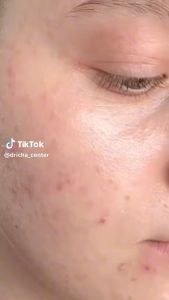 Dricha Acne Skin Essence (Lavender Essential Oil)