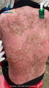 Leeva Sabun Exotic Acne - Sabun Wajah Jerawat & Komedo 100g - Anti Bacterial & Oil Control