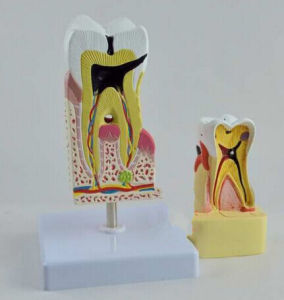 Tooth Decay Model Dental Anatomy Cross Section Model Comprehensive Pathological Model of Tooth Diseases Dental Care Teaching Toy