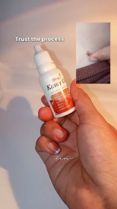 Blairy Essentials Kasoy Oil Serum 15ml & Cream 10g - Skin Tag & Wart Remedy Skin Renewal Natural Ingredients