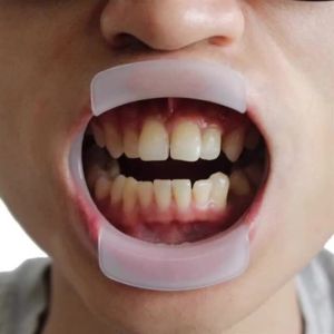 1PCS Dental O-Shape Intraoral Lip Cheek Retractor Mouth Opener Oral Hygiene Teeth Whitening Expanders Orthodontic Brace Tools