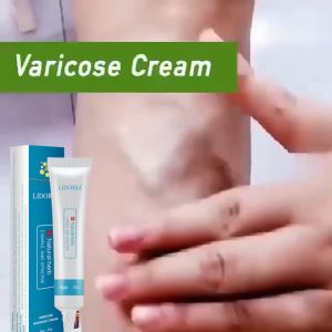 Varicose Veins Treatment Cream Effective Phlebitis Pain Relief Ointment Varicose Veins Cream Varicose Vein Removal