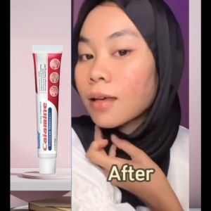 【Sumifun】 obat jerawat yang ampuh obat jerawat paling ampuh cewek-Acne Cream penghilang jerawatdan bekas Penghilang Jerawat Obat Jerawat Yang Ampuh Menghaluskan Pengurangan jerawat 20g