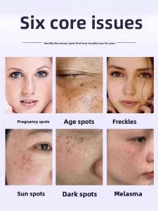 CHUNCHANG | Nicotinamide Whitening Spot Remover Cream for Age Spots on Hands and Face