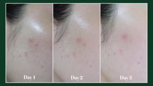 เจลแต้มสิว ดร.สมชาย สูตรเร่งด่วน สิวแห้ง ยุบเร็ว ลดอักเสบ สิวหัวหนอง ทาทับเครื่องสำอางได้ ไม่ทิ้งคราบ